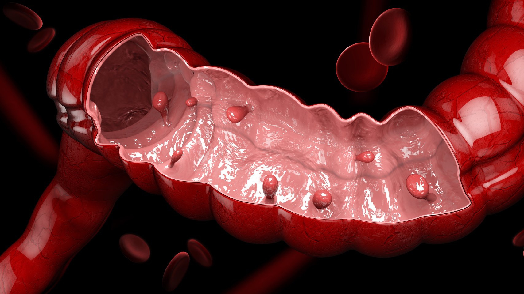 Gastrointestinal polyps 1000062403